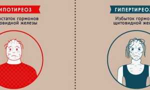 Гипертиреоз и гипотиреоз