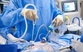 Лапароскопия яичников и беременность