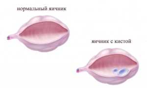 Кистозно-измененные яичники