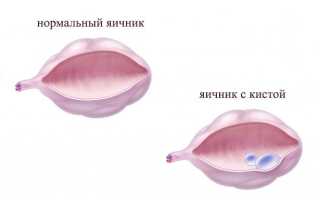 Кистозно-измененные яичники