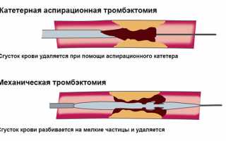 Поможет очистить сосуды от закупорки операция тромбэктомия: варианты проведения, особенности