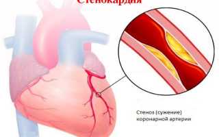 Важные и нужные препараты для профилактики инсульта