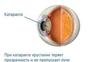 Насколько опасна и как лечится ретинопатия недоношенных