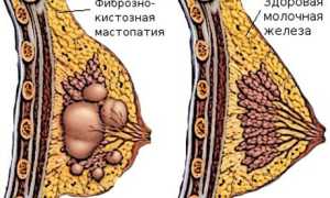 Лечение фиброзной мастопатии молочных желез