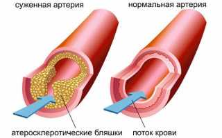 Каким бывает давление при гипотиреозе