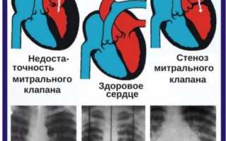 Опасный сочетанный порок сердца: в чем его особенности и как лечить