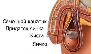 Киста яичка