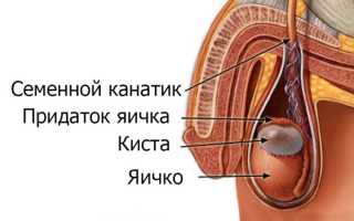 Киста яичка