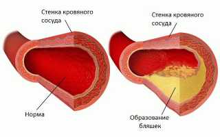 Что такое транзиторная ишемическая атака, причины ее появления и лечение