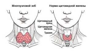 Многоузловой зоб щитовидной железы