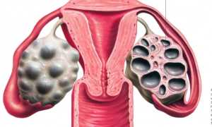 Кистозная дегенерация яичников