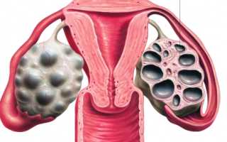 Кистозная дегенерация яичников