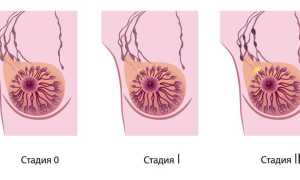 Признаки рака грудной железы