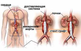 Восстанавливающая реконструкция сосудов: что могут предложить хирурги?