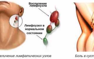 Почему возникает и как лечится аллергический васкулит у взрослых и детей