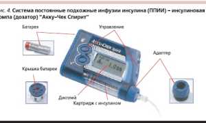 Инсулиновая помпа