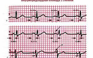 Почему возникает и как лечится нарушение внутрипредсердной проводимости