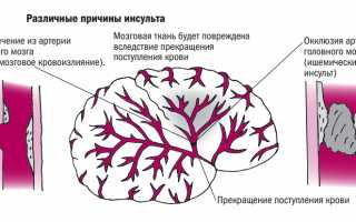 Когда можно начинать лечение инсульта народными средствами и какие лучше применять