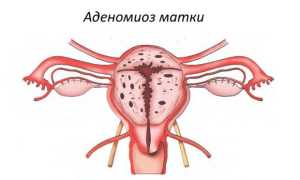 Беременность при аденомиозе матки