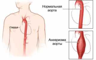 Закупорка или стеноз почечной артерии