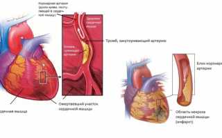 Что представляет собой инфаркт миокарда и его последствия
