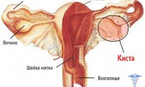 Фолликулярная киста яичника