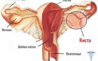 Фолликулярная киста яичника