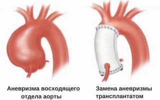 Патология аневризма аорты: операция как шанс на спасение