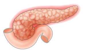 Билиарный панкреатит