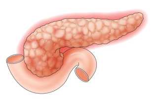 Билиарный панкреатит