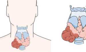 Фолликулярная опухоль щитовидной железы