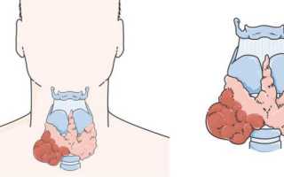 Фолликулярная опухоль щитовидной железы