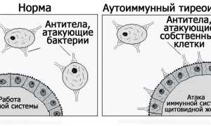 АИТ щитовидной железы: симптомы и лечение