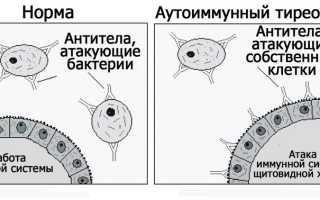 АИТ щитовидной железы: симптомы и лечение