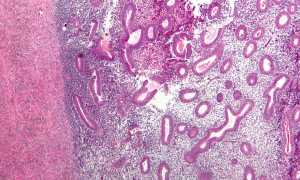 Эндометриоз яичников: симптомы и лечение