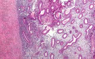 Эндометриоз яичников: симптомы и лечение