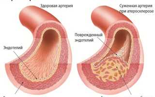 Как возникает и чем грозит атеросклероз в головном мозге?