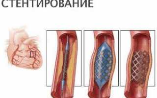 Замедление импульсной проводимости или внутрижелудочковая блокада: признаки, причины и решение проблемы