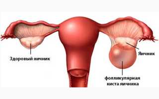 Разрыв фолликулярной кисты яичника