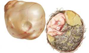 Тератома яичника – что это такое?