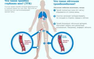 Почему возникает тромбофлебит после операции и как его избежать?