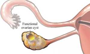 Функциональная киста яичника