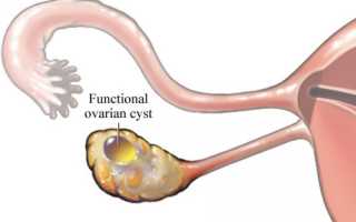 Функциональная киста яичника