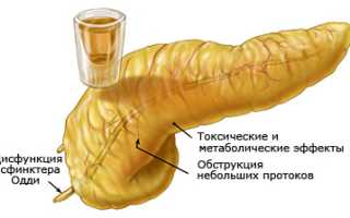 Если боль отдает в спину при панкреатите