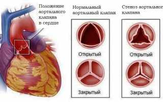 Что стоит знать о протезировании клапанов сердца