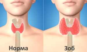 Калькульозно-дегенерирующий узловой зоб