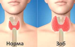 Калькульозно-дегенерирующий узловой зоб