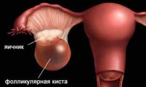 Лечение фолликулярной кисты яичника народными средствами