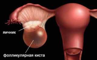 Лечение фолликулярной кисты яичника народными средствами