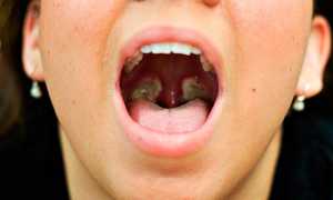 Чистка миндалин от пробок